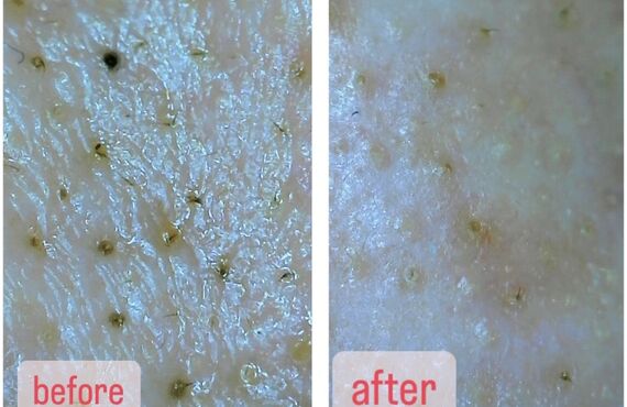 汚れや角質が詰まった毛穴を綺麗に洗浄！最新機能を使ったフェイシャル技術💛